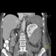 Renal hemorrhage, staghorn calculus: CT - Computed tomography